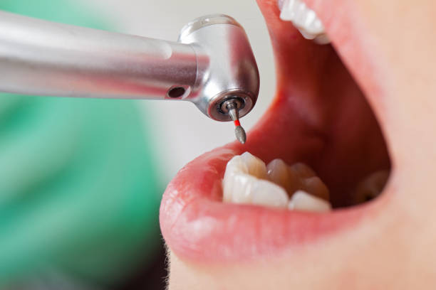 Best Emergency Dental Care for Broken or Chipped Teeth in Beecher, MI
